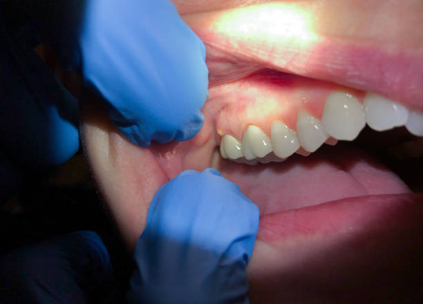 Best Dentist for Tooth Abscess  in New Hackensack, NY